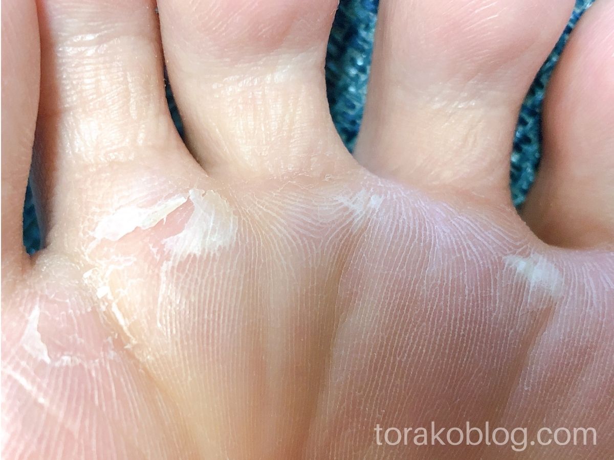 リベンジ ベビーフット 2回目の使用で足裏の角質ケアに成功 きらくらし